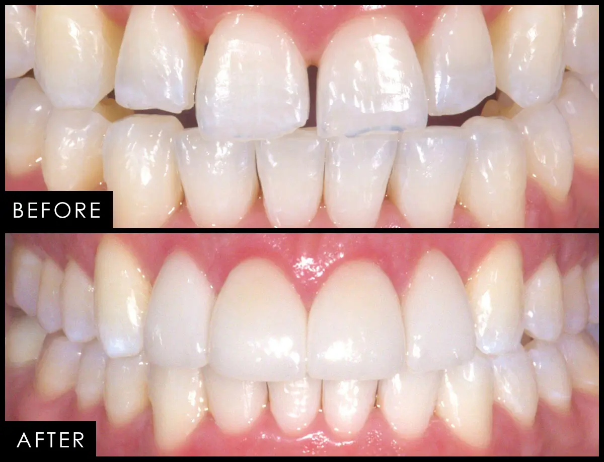 Before and after