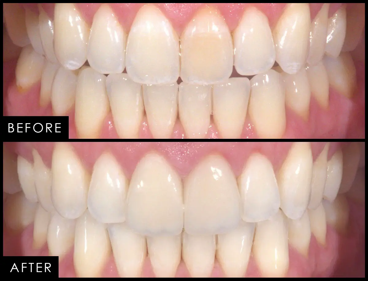Before and after